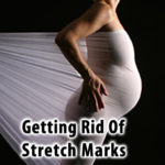 Getting Rid of Stretch Marks